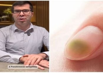 Ricardo Kores, infectologista “A famosa síndrome da unha verde”