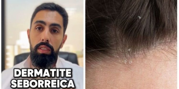 Saiba como alguns alimentos podem aumentar a sua dermatite seborreica / Foto: (Fonte/Instagram @drhusseinawada / Créditos: depositphotos.com / vkiroj@gmail.com)