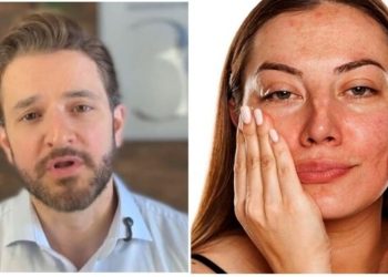 Rubens Pontello, dermatologista "Quem tem melasma pode fazer laser?"