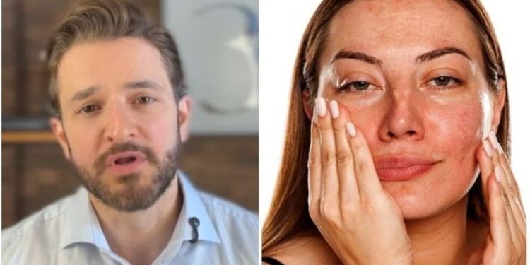 Rubens Pontello, dermatologista "Quem tem melasma pode fazer laser?"