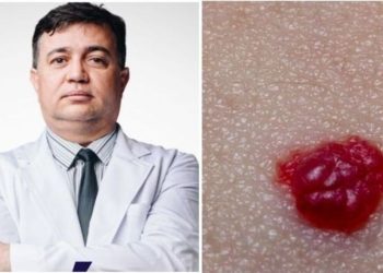 Cleuber Barbosa, "Hemangioma vira câncer?"