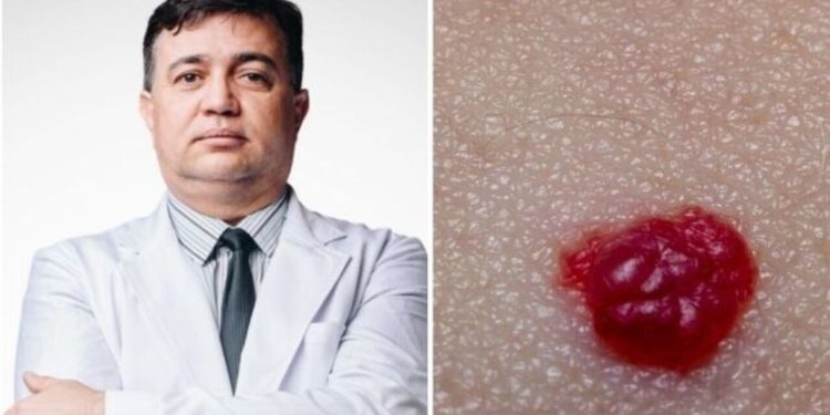 Cleuber Barbosa, "Hemangioma vira câncer?"