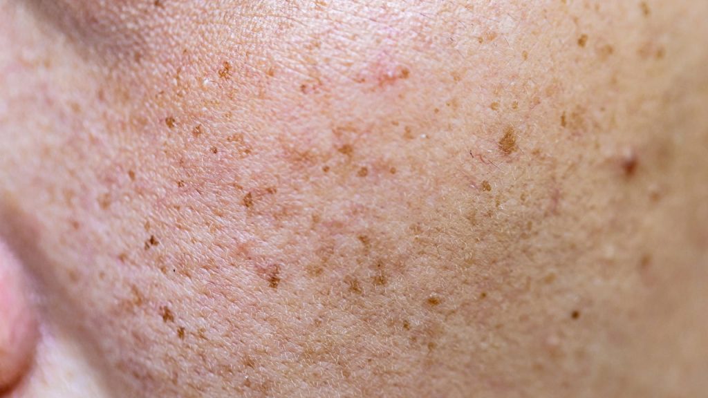Melasma / Créditos: depositphotos.com / lobster20