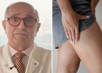 Roque Savioli, médico "Pernas inchadas nem sempre são retenção de líquido"
