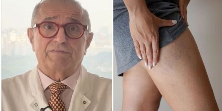 Roque Savioli, médico "Pernas inchadas nem sempre são retenção de líquido"