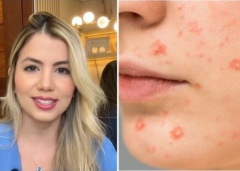 Mayra Nicodemos, dermatologista "Você sabia que existem diferentes graus de acne?"