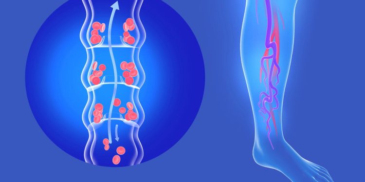 Os melhores exercícios para aliviar varizes e pernas pesadas