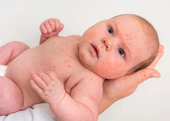 Sinais de alergia em bebê que todo responsável deve conhecer