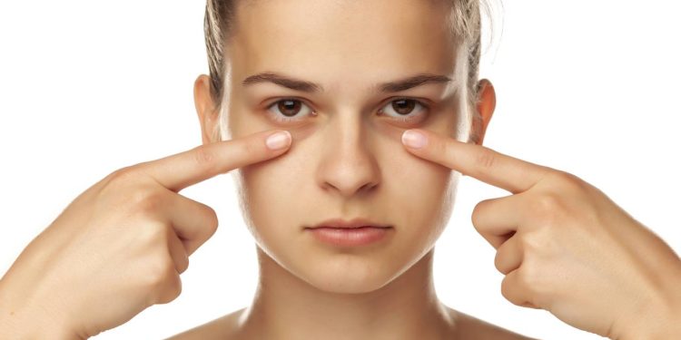 Olheiras: o que as causa e 5 soluções eficazes para reduzi-las ou disfarçá-las