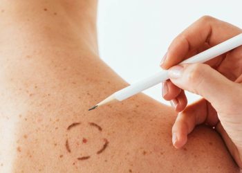 Dermatologistas alertam sobre novas pintas na pele