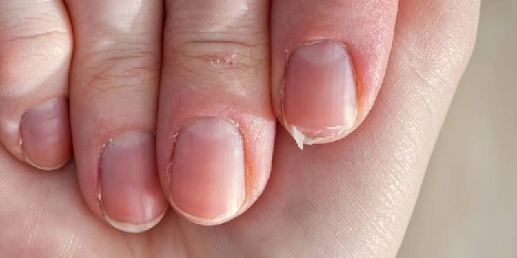 Como fortalecer as unhas fracas e quebradiças com cuidados naturais