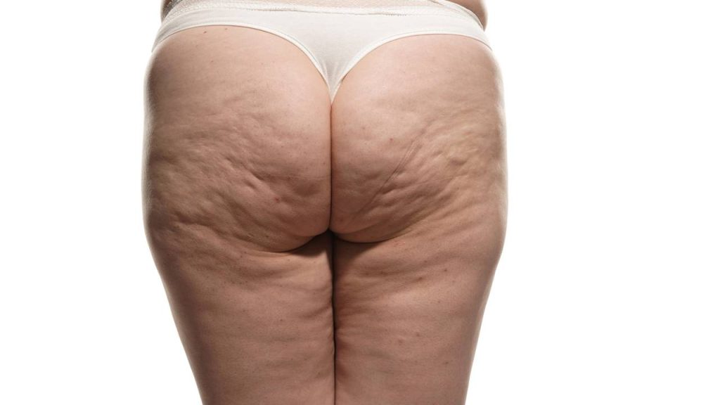 flacidez no bumbum