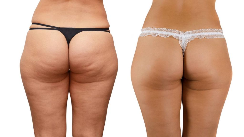 flacidez no bumbum