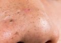 10 maneiras naturais de eliminar cravos gastando pouco