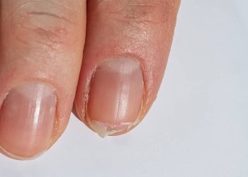 Unhas quebradiças? Saiba como fortalecê-las com hábitos simples