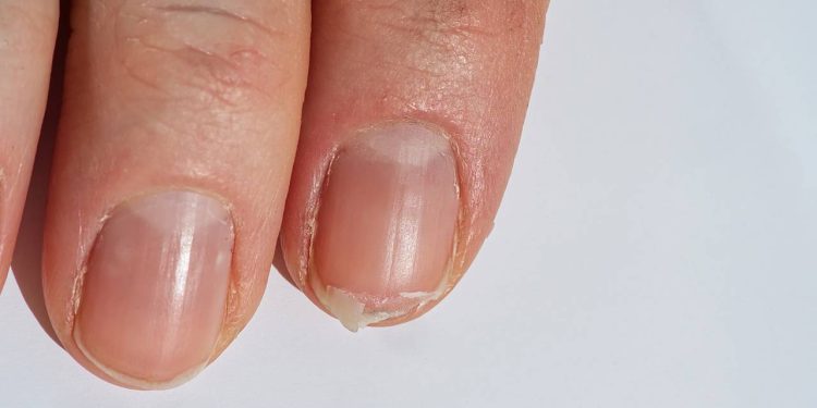 Unhas quebradiças? Saiba como fortalecê-las com hábitos simples