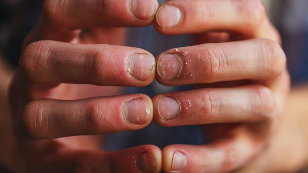 unhas quebradiças