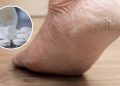 Como acabar com pés rachados usando aspirina, segundo especialistas
