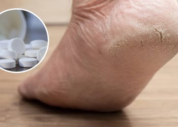 Como acabar com pés rachados usando aspirina, segundo especialistas
