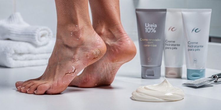 3 cremes de farmácia que dermatologistas indicam para hidratar rapidamente pés ressecados