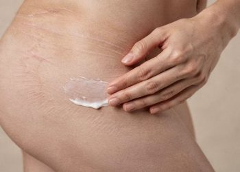 Estrias roxas, vermelhas ou brancas? Esses 2 produtos podem acabar com as suas estrias