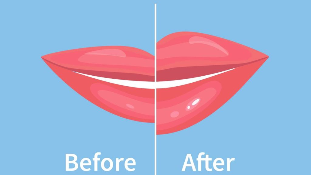 preenchimento labial caseiro