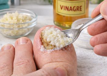 Mistura de alho, vinagre e bicarbonato pode ser a solução para unhas amareladas e com fungos