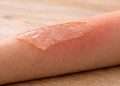 Como fazer gel de aloe vera em minutos e aliviar a pele irritada pela queimadura do sol