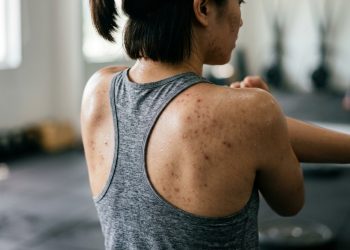 Os 5 exercícios fáceis para reduzir a acne e o estresse hormonal