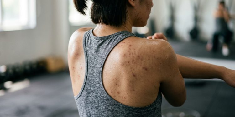 Os 5 exercícios fáceis para reduzir a acne e o estresse hormonal
