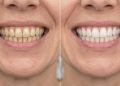 Quanto custa clarear os dentes em 2026 e remover manchas amareladas?