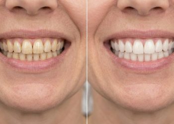 Quanto custa clarear os dentes em 2026 e remover manchas amareladas?