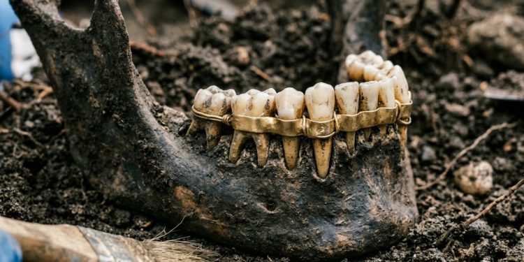 Essa mandíbula medieval revela a primeira “ponte dentária” conhecida na Escócia, feita com peças de ouro de 20 quilates