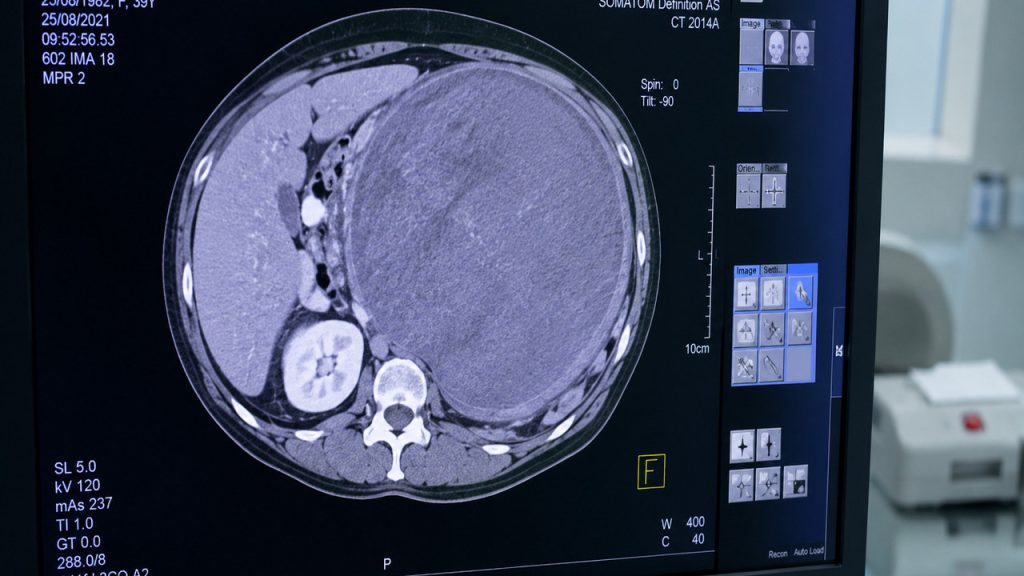 tumor