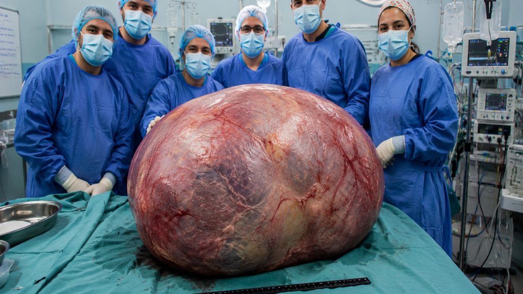 tumor